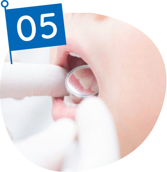 精密検査・再評価（第II期治療前）